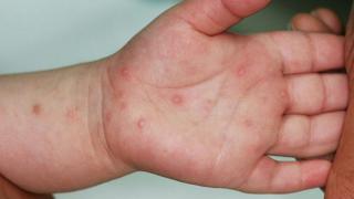 Phòng Ngừa Bệnh Chân Tay Miệng Ở Trẻ