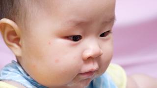 Bệnh Rubella Ở Trẻ Và Thông Tin Mẹ Cần Biết