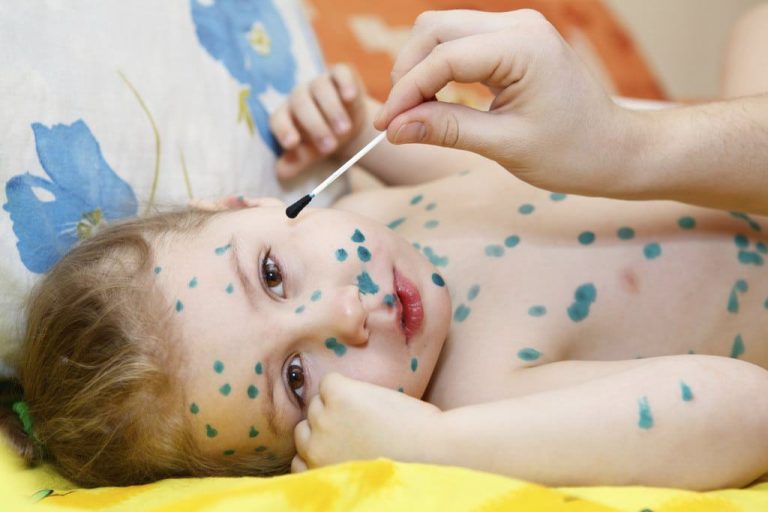 Những Điều Bố Mẹ Cần Biết Về Bệnh Thủy Đậu Ở Trẻ Em