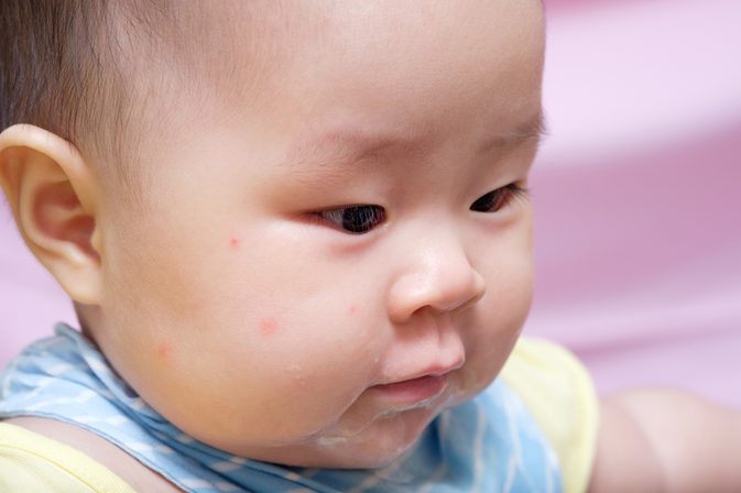 Bệnh Rubella Ở Trẻ Và Thông Tin Mẹ Cần Biết
