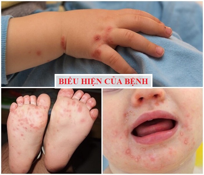 Bệnh Tay Chân Miệng Ở Trẻ Em Và Những Điều Cần Lưu Ý