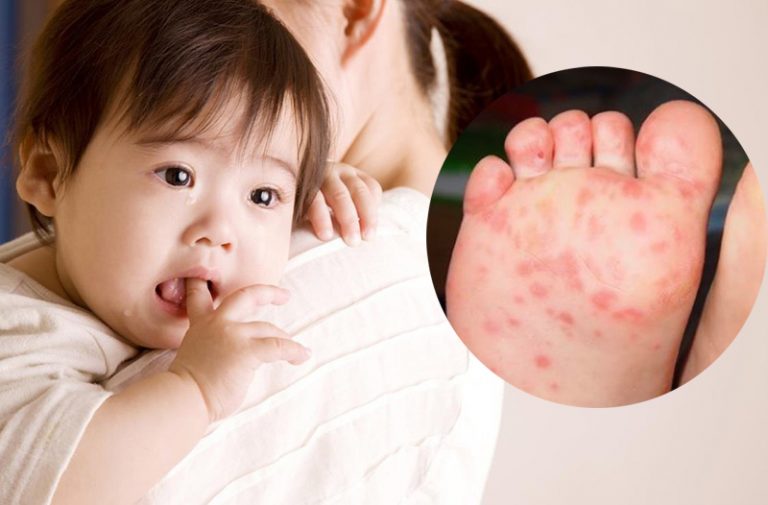 Bệnh Tay Chân Miệng Ở Trẻ Em Và Những Điều Cần Lưu Ý