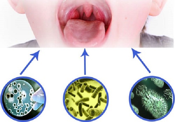 Viêm Họng Ở Trẻ Em - Tìm Hiểu Nguyên Nhân Và Điều Trị