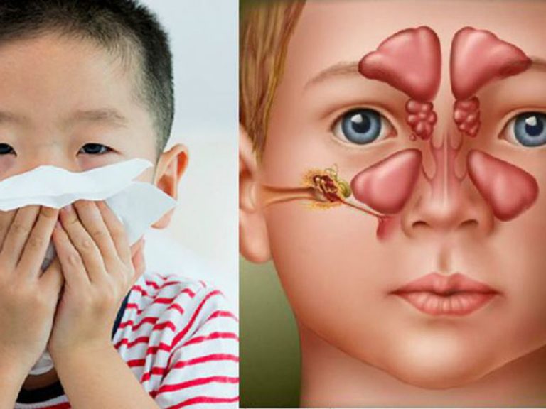 Viêm Xoang Ở Trẻ Và Những Điều Cần Biết