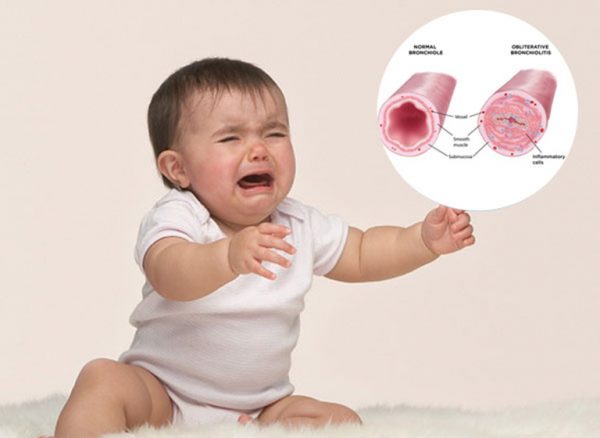 Đề Phòng Viêm Tiểu Phế Quản Ở Trẻ Khi Trời Lạnh