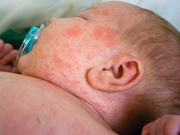 Sốt Phát Ban Ở Trẻ: Chăm Sóc Và Điều Trị Đúng Cách