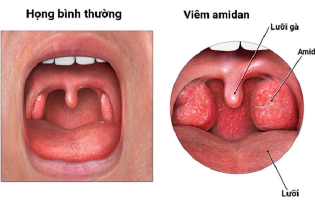 Viêm Amidan Ở Trẻ Và Những Điều Cần Biết