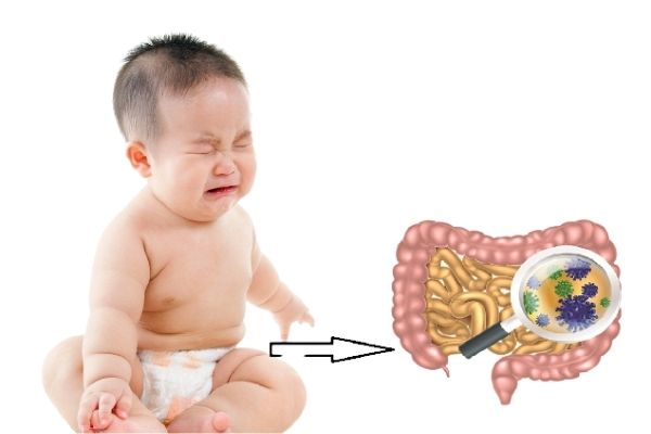 Viêm Ruột Ở Trẻ Em: Bố Mẹ Tuyệt Đối Không Lơ Là
